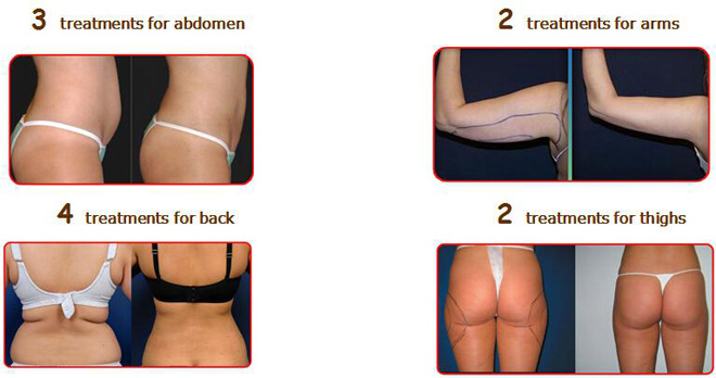 Lipo Laser Treatment Lipo laser treatment