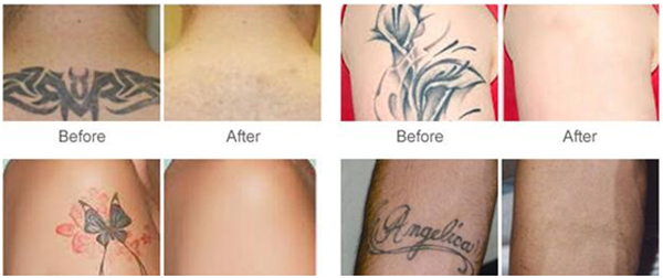 K10 Nd Yag Laser Tattoo Removal Machine-ipl Laser Device-guangzhou Vantee Electronic Technology Coltd